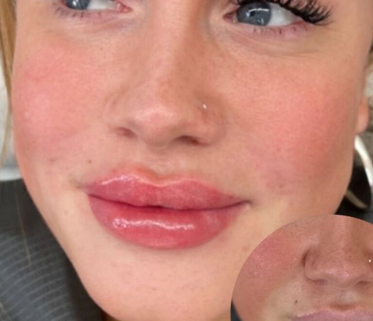 Lip Fillers